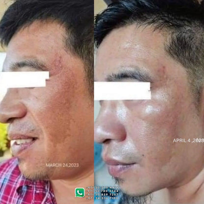 Her Choice Ph - Pekas Remover Cream -50g