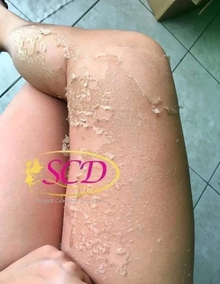 SCD Peeling Skin Lotion 100ml – ROSYSKIN ESSENTIALS LLC